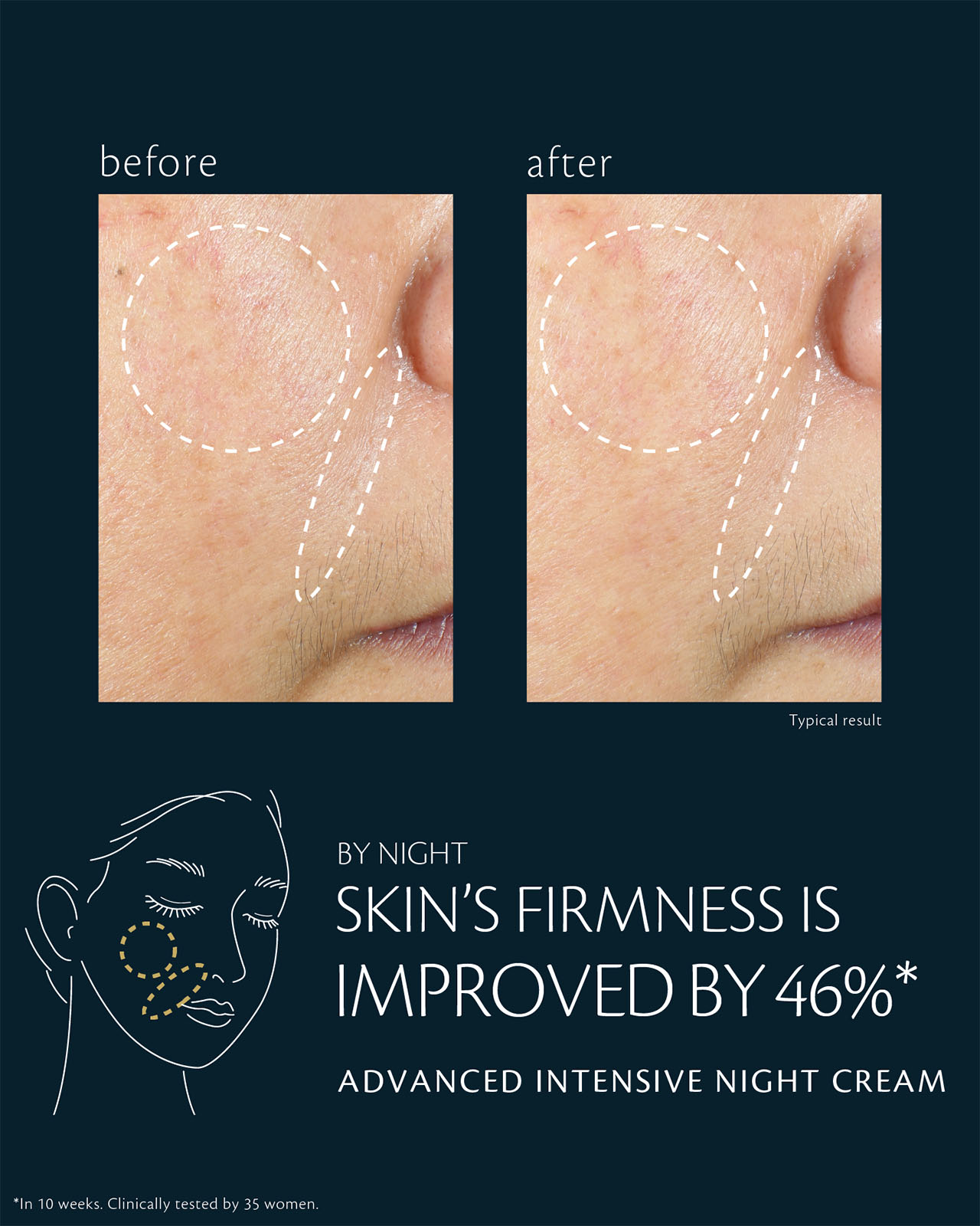 Photo of before-and-after comparison of cheek skin condition using ADVANCED INTENSIVE NIGHT CREAM. The left “before” image shows a lack of firmness, while the right “after” image shows a 46% improvement in firmness. Based on a 10-week clinical test with 35 women.